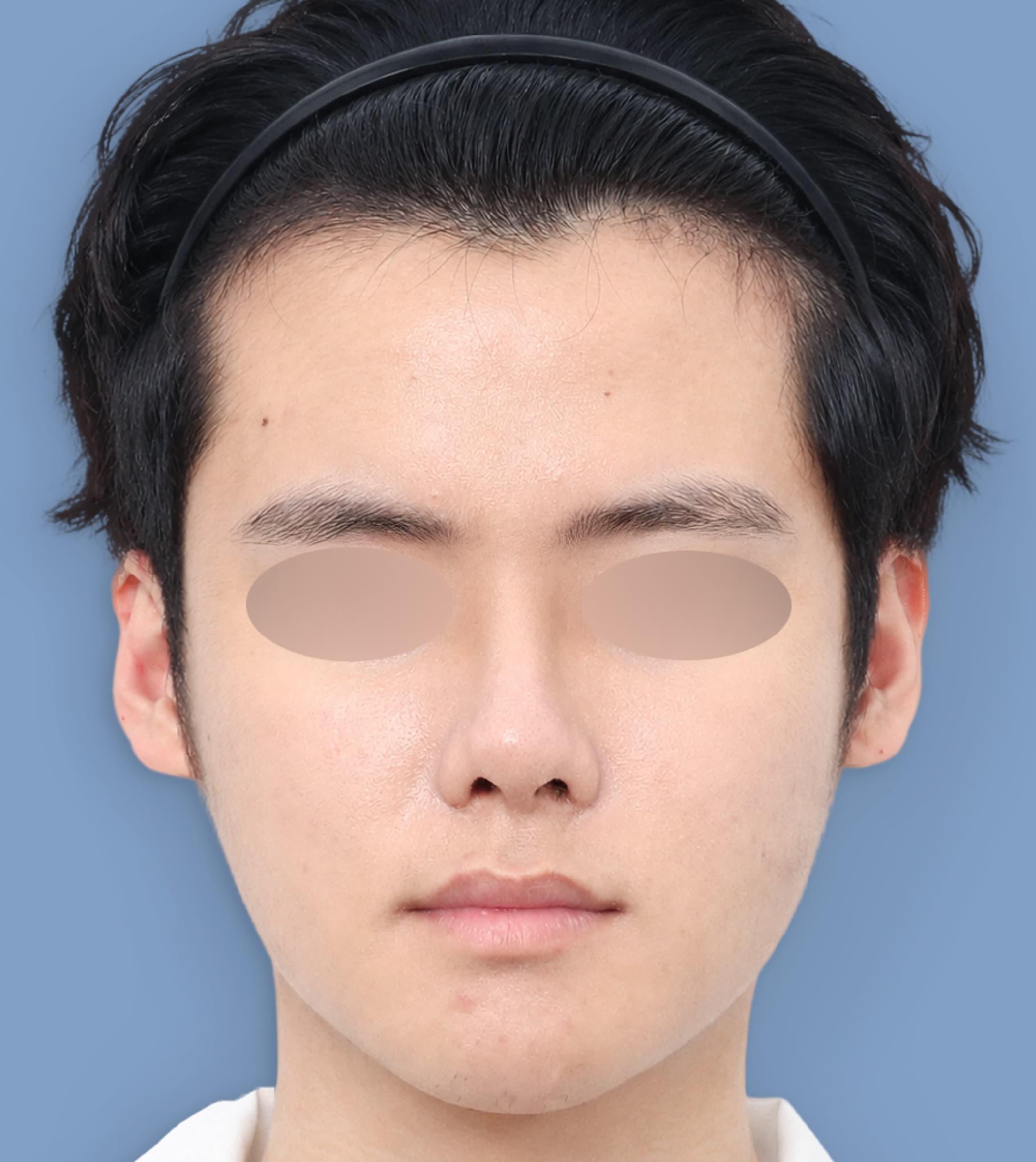 輪郭バランス3点＋脂肪移植＋貴族手術 30代 正面 術後