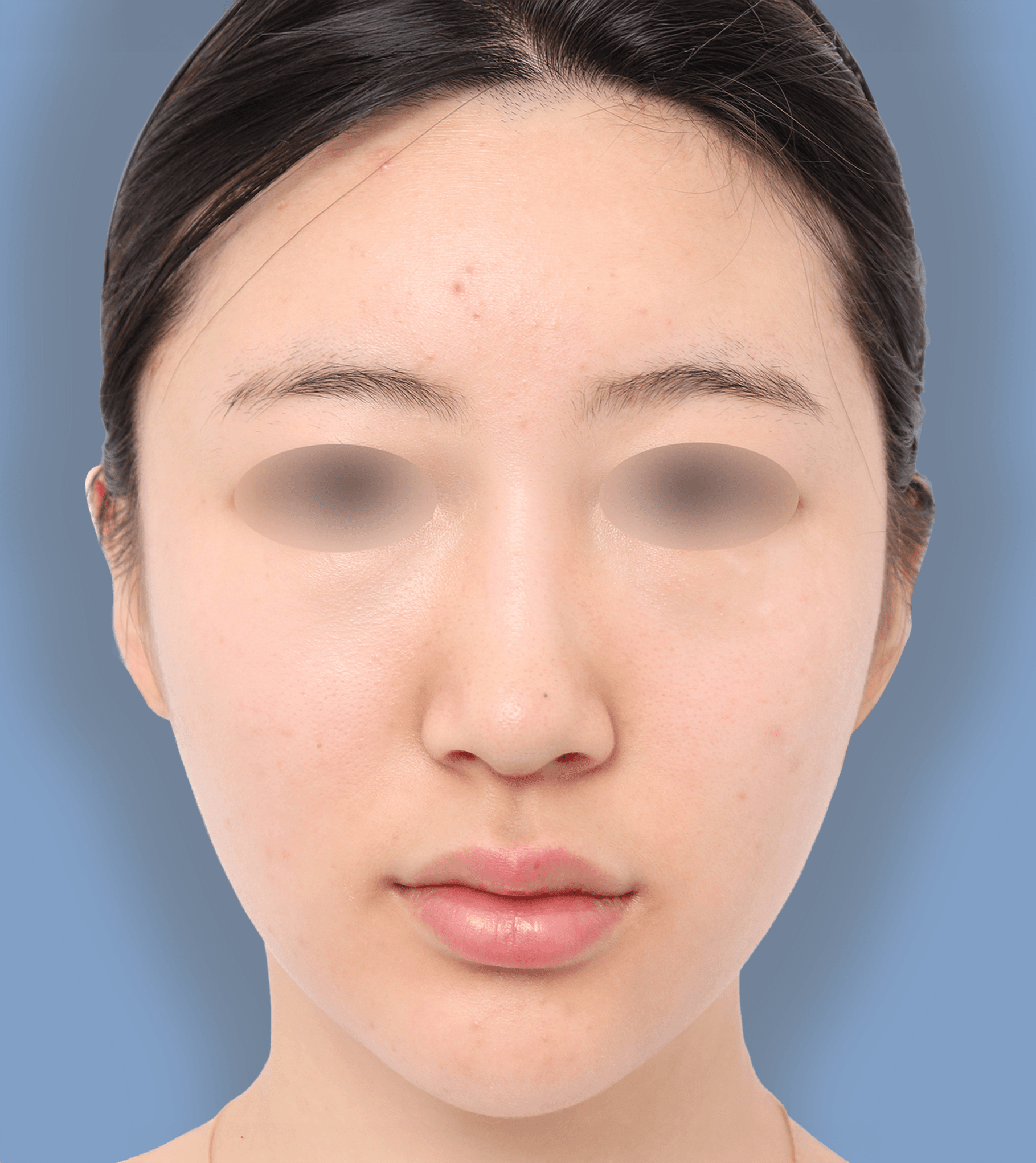 頬骨縮小＋非対称矯正 30代 正面 術後