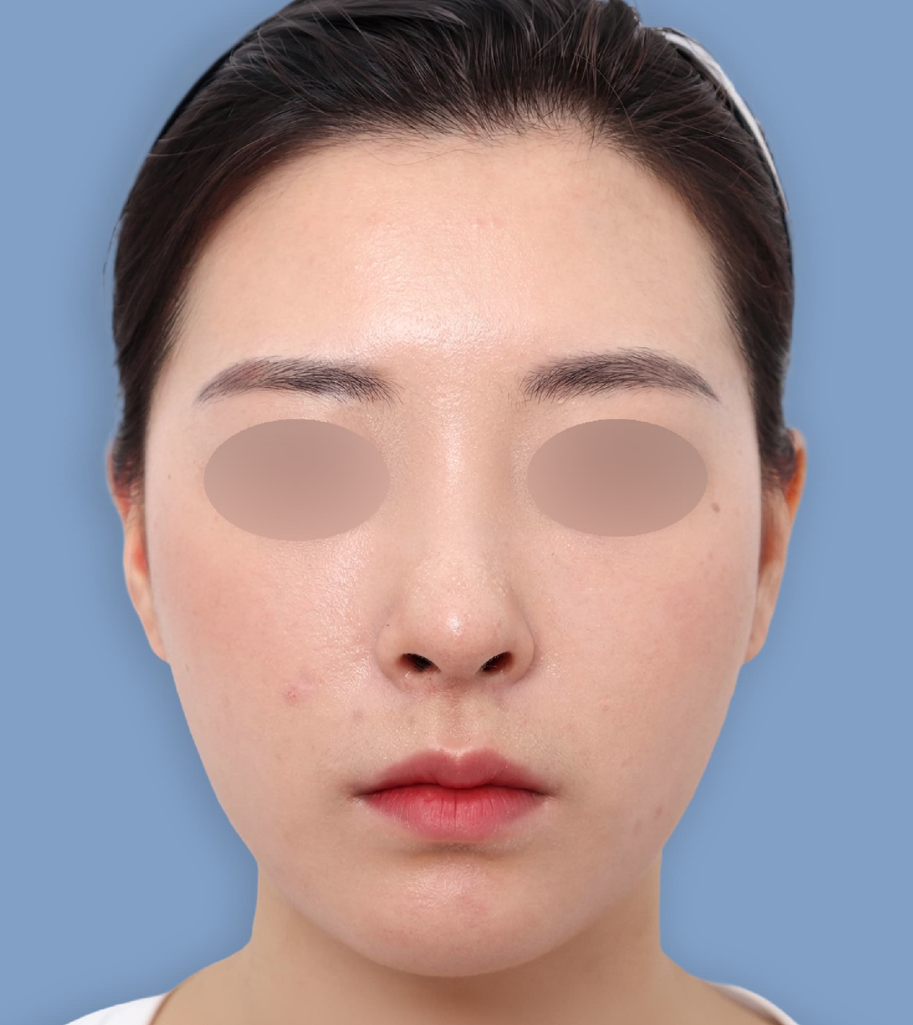 頬骨縮小再手術 20代 正面 術後