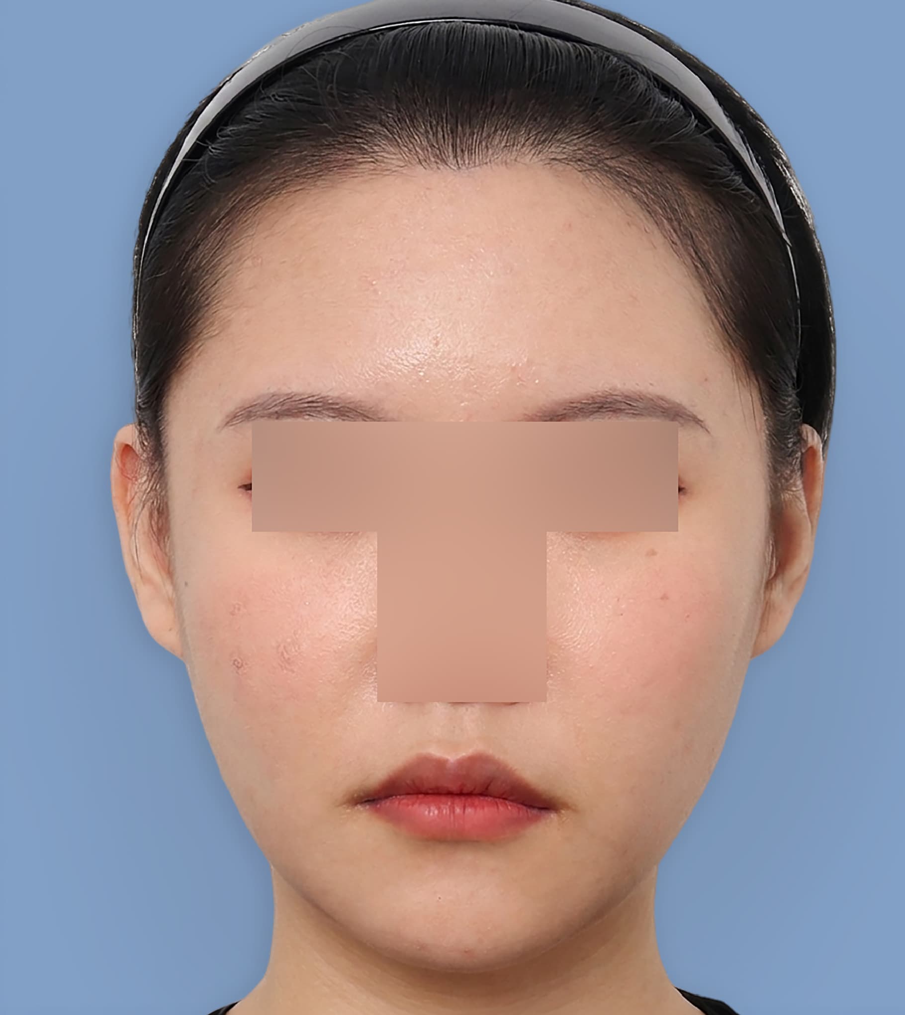 輪郭2点（エラ再手術+頬骨縮小再手術） 20代 正面 術後