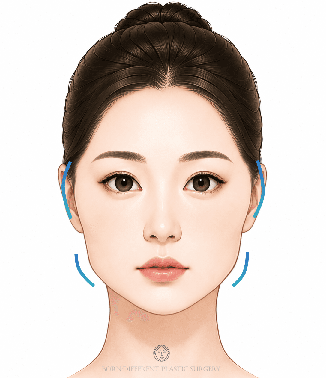頬骨縮小＋エラ削りのイメージイラスト