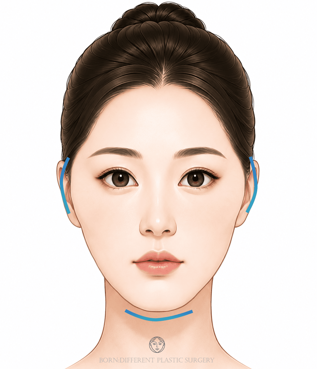 頬骨縮小＋顎先形成のイメージイラスト