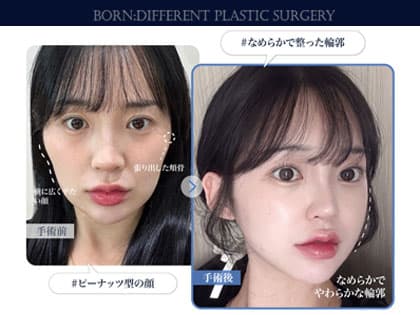 輪郭3点のダウンタイム解説記事のイメージ