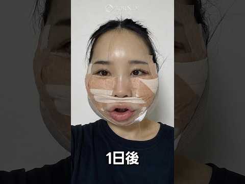 輪郭手術レポのショート動画サムネイル