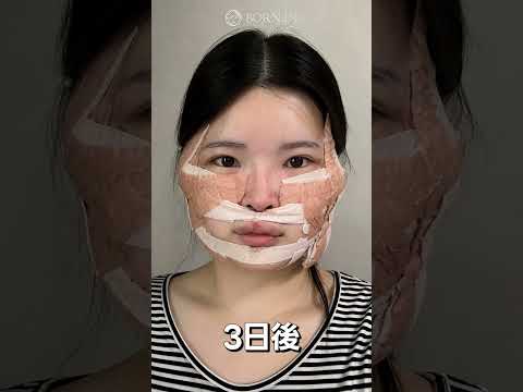 輪郭手術レポのショート動画サムネイル