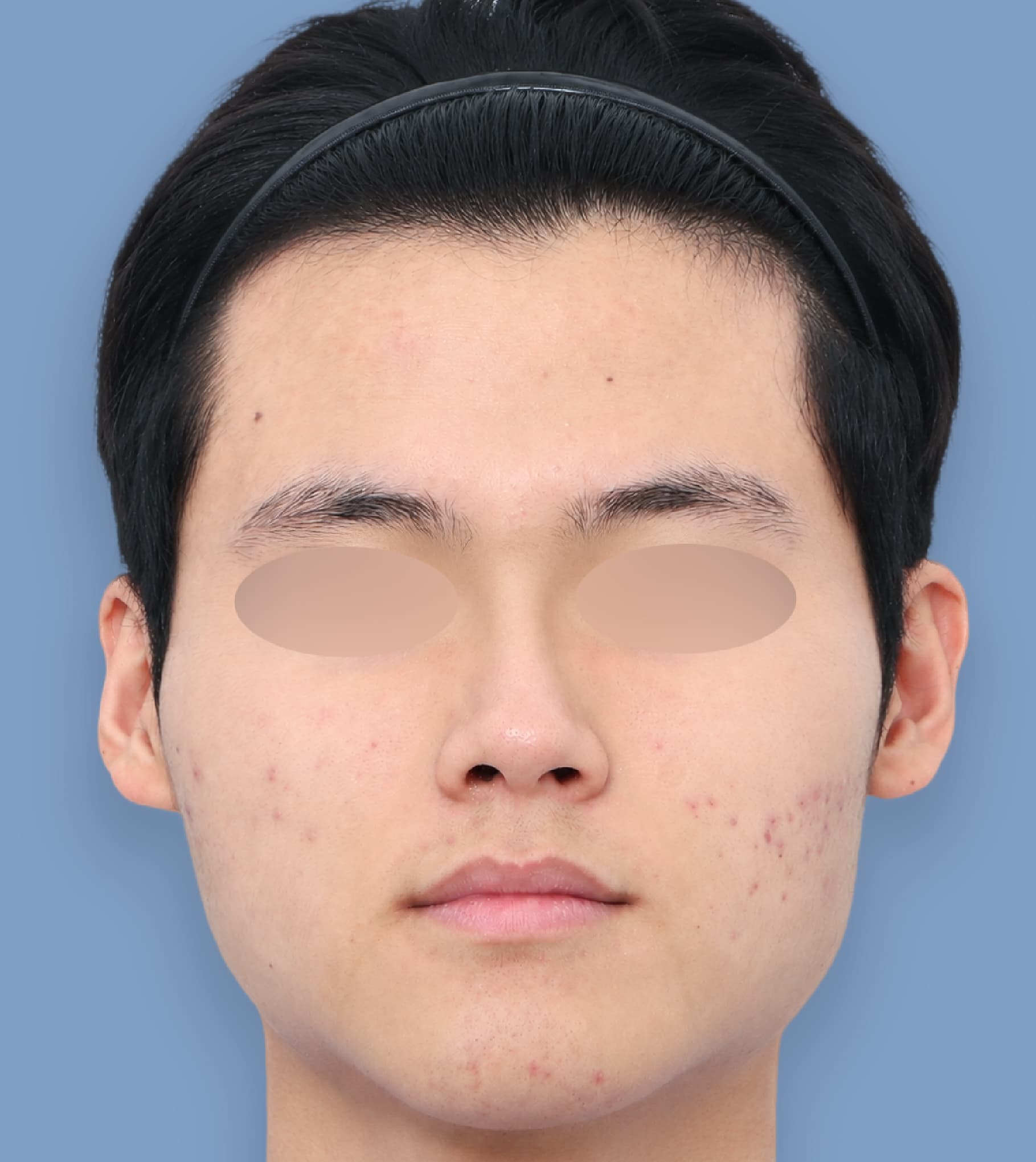 輪郭バランス3点+脂肪移植+貴族手術 30代 正面 術前