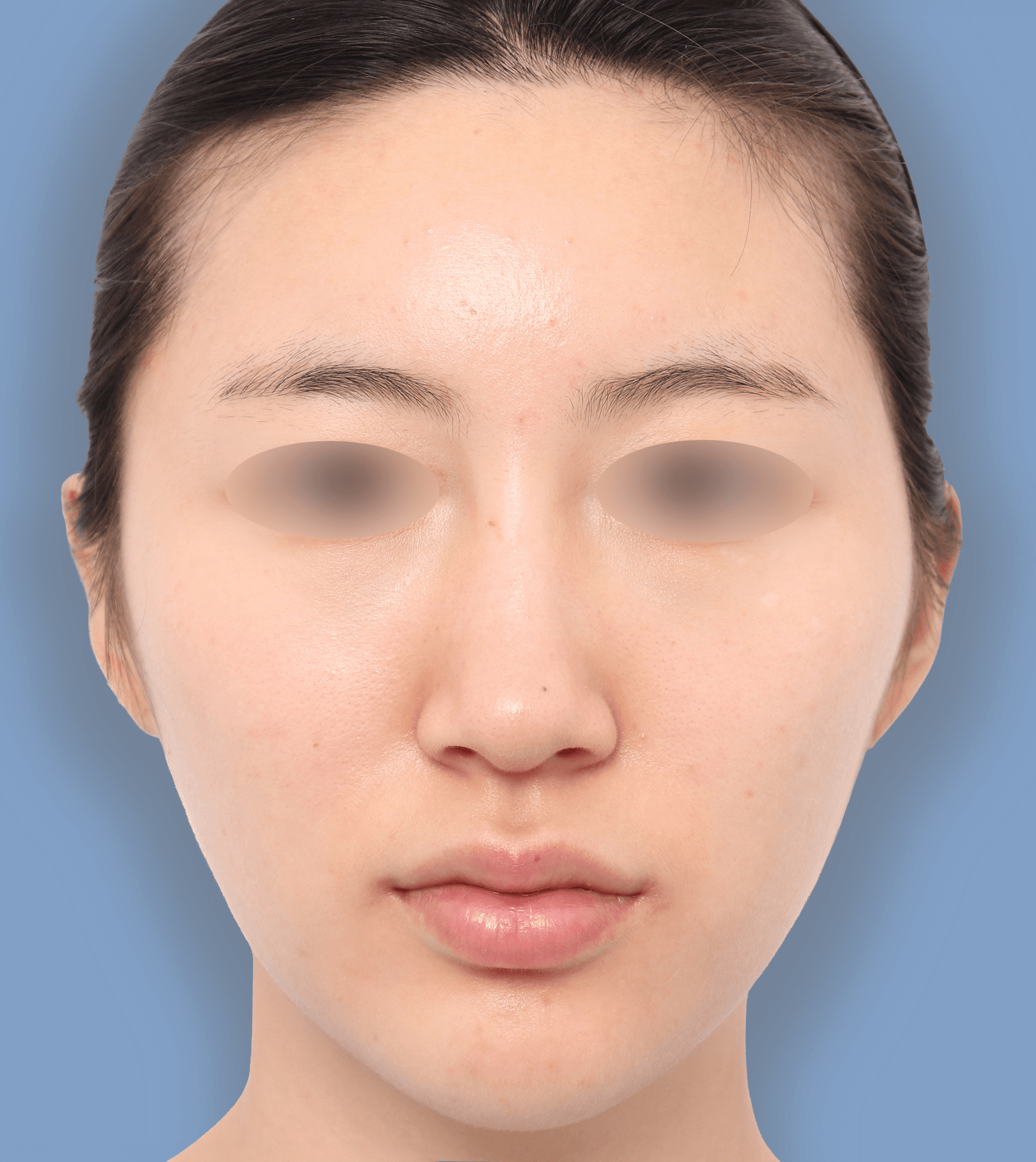 頬骨縮小+非対称矯正 30代 正面 術前