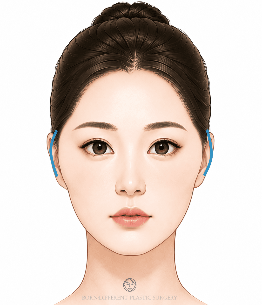 頬骨縮小のイメージイラスト