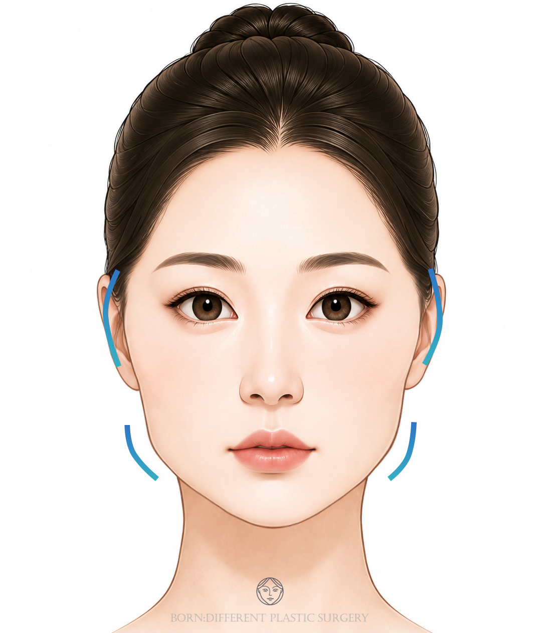 頬骨縮小+エラ削りのイメージイラスト