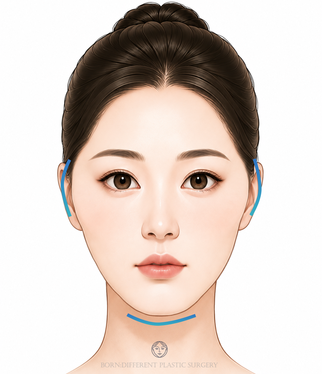 頬骨縮小+顎先形成のイメージイラスト