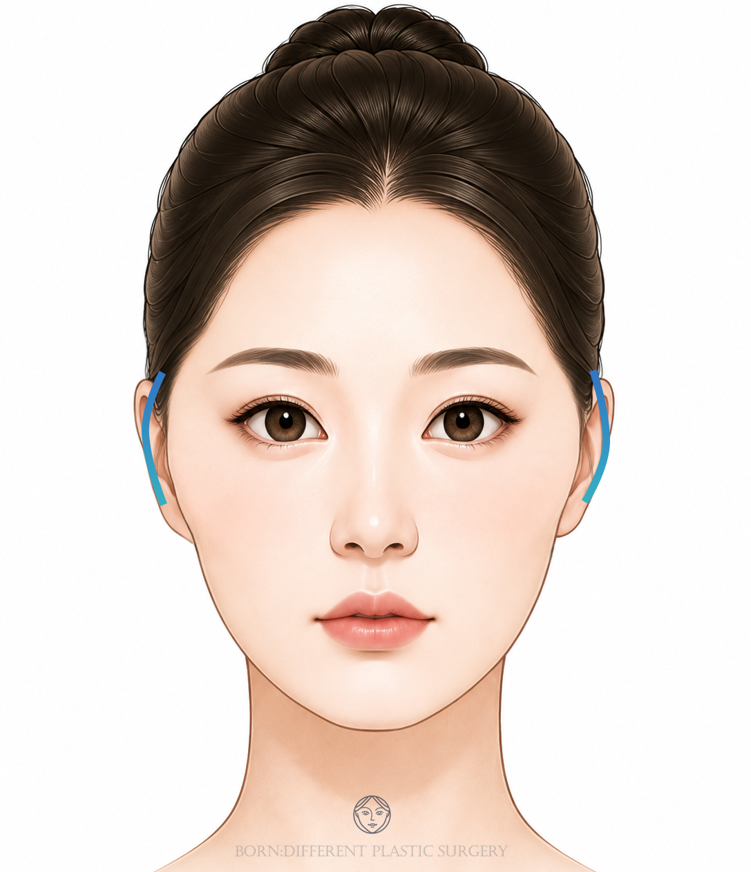 頬骨縮小のイメージイラスト